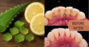 Dental plaques & teeth cleaning