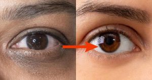 Remedy for dark circles under eyes