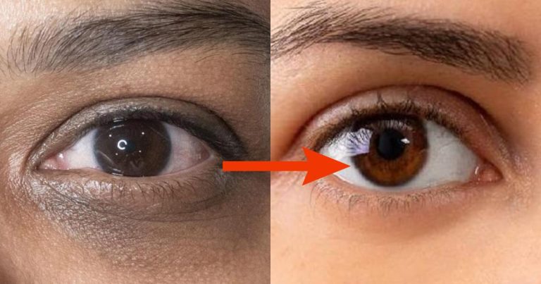 Remedy for dark circles under eyes
