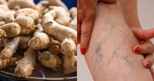 Varicose veins removal using ginger
