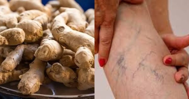 Varicose veins removal using ginger