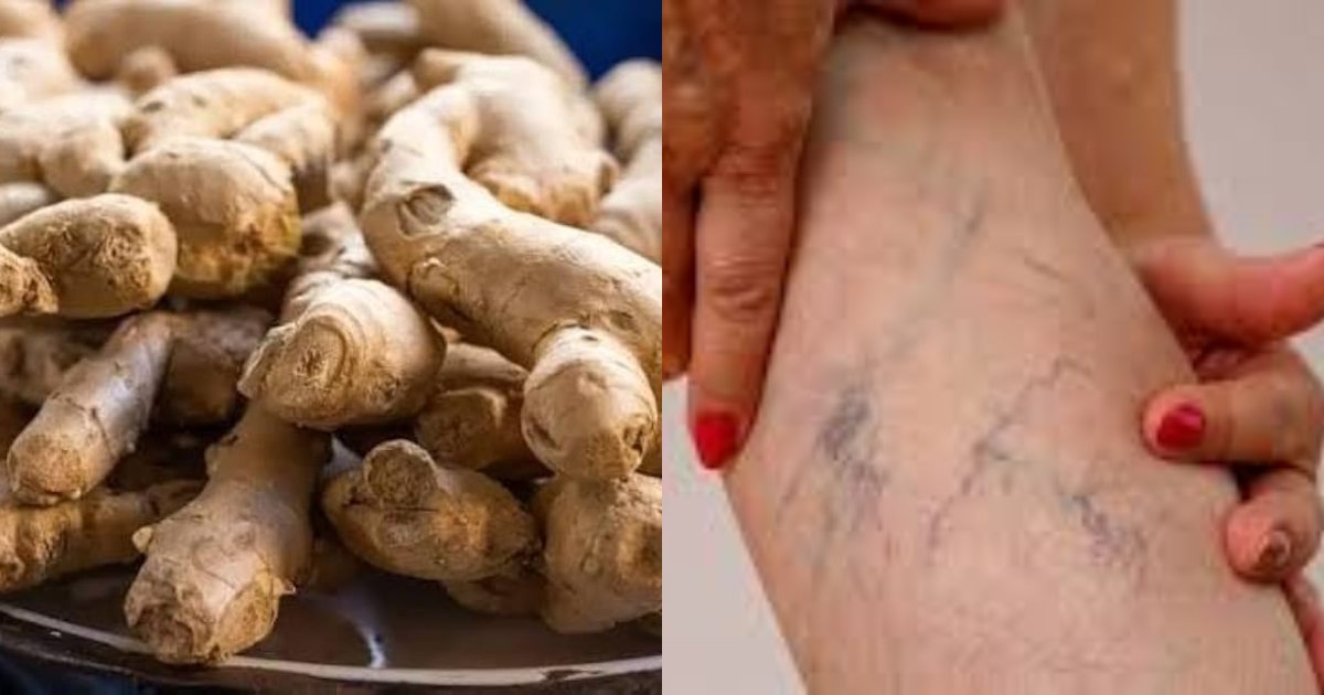 Varicose veins removal using ginger